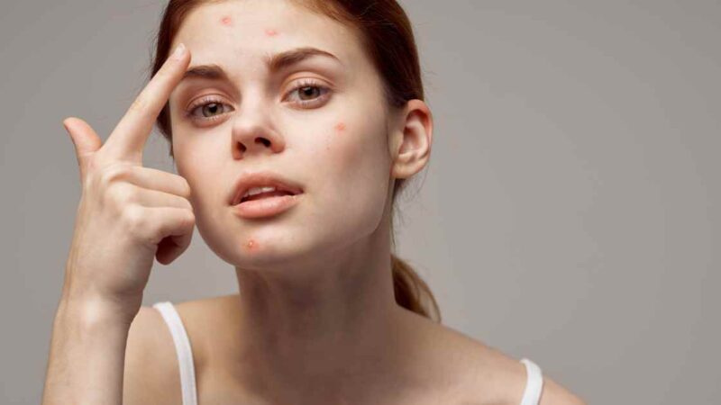 Expert Tips for Healthier Skin: Acne-Prone Skin Care Routine