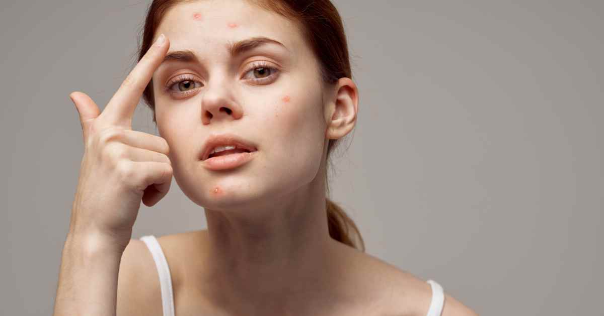 Acne-Prone Skin Care Routine