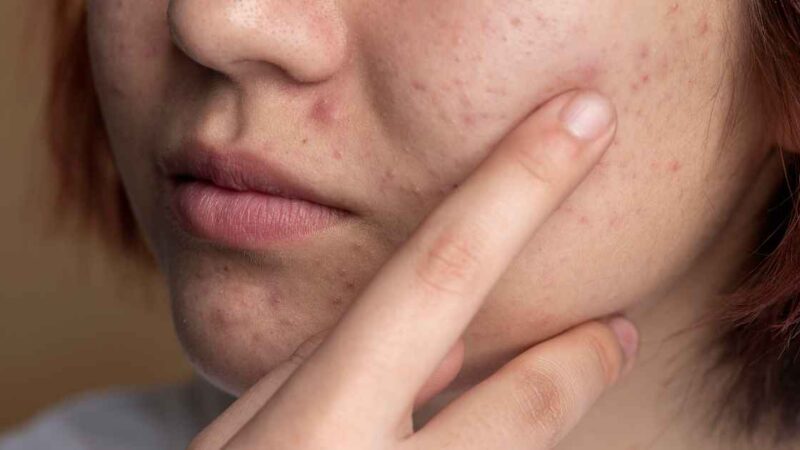 Acne or Something Else? The Importance of Accurate Diagnosis through Skin Tests