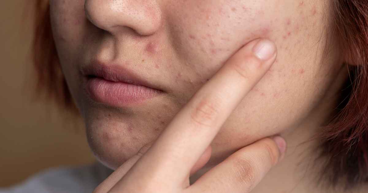 Acne or Something Else? The Importance of Accurate Diagnosis through Skin Tests