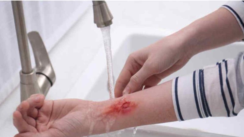 Skin Care Essentials: How to Handle Minor Wounds and Infections